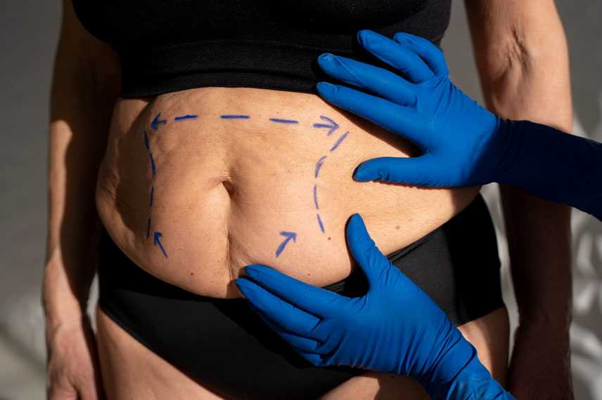 قبل از عمل اسلیو معده جهت آمادگی برای روز قبل از عمل اسلیو معده، با پزشک خود مشورت کنید.