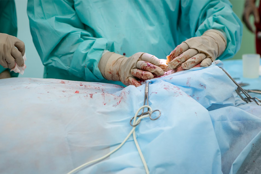 جراحی اسلیو معده نشت معده بعد از اسلیو باعث میشود که مایعات گوارشی از داخل معده به داخل حفره شکم ریخته شود.