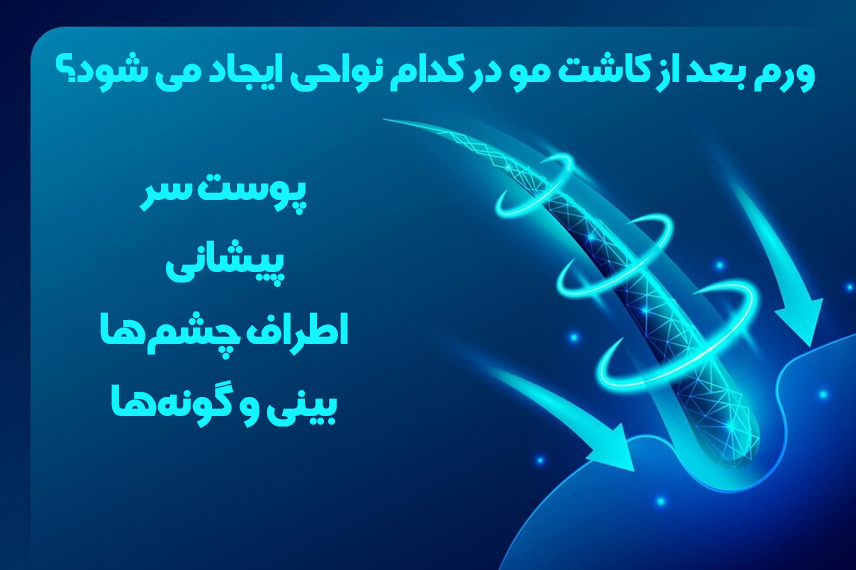 نواحی ورم صورت بعد از کاشت مو