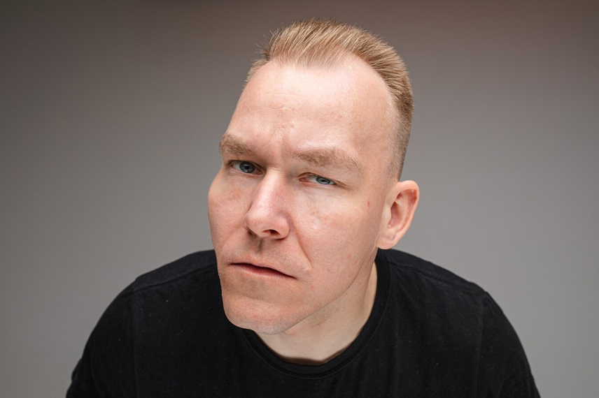 ورم بعد از کاشت مو بخشی از پروسه بهبودی پس از عمل است.