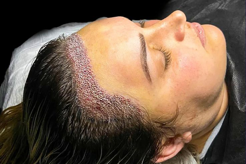 نتیجه نهایی کاشت مو میکروگرافت نتیجه نهایی کاشت مو میکروگرافت حدود 9 تا 12 ماه پس از عمل مشخص می شود.